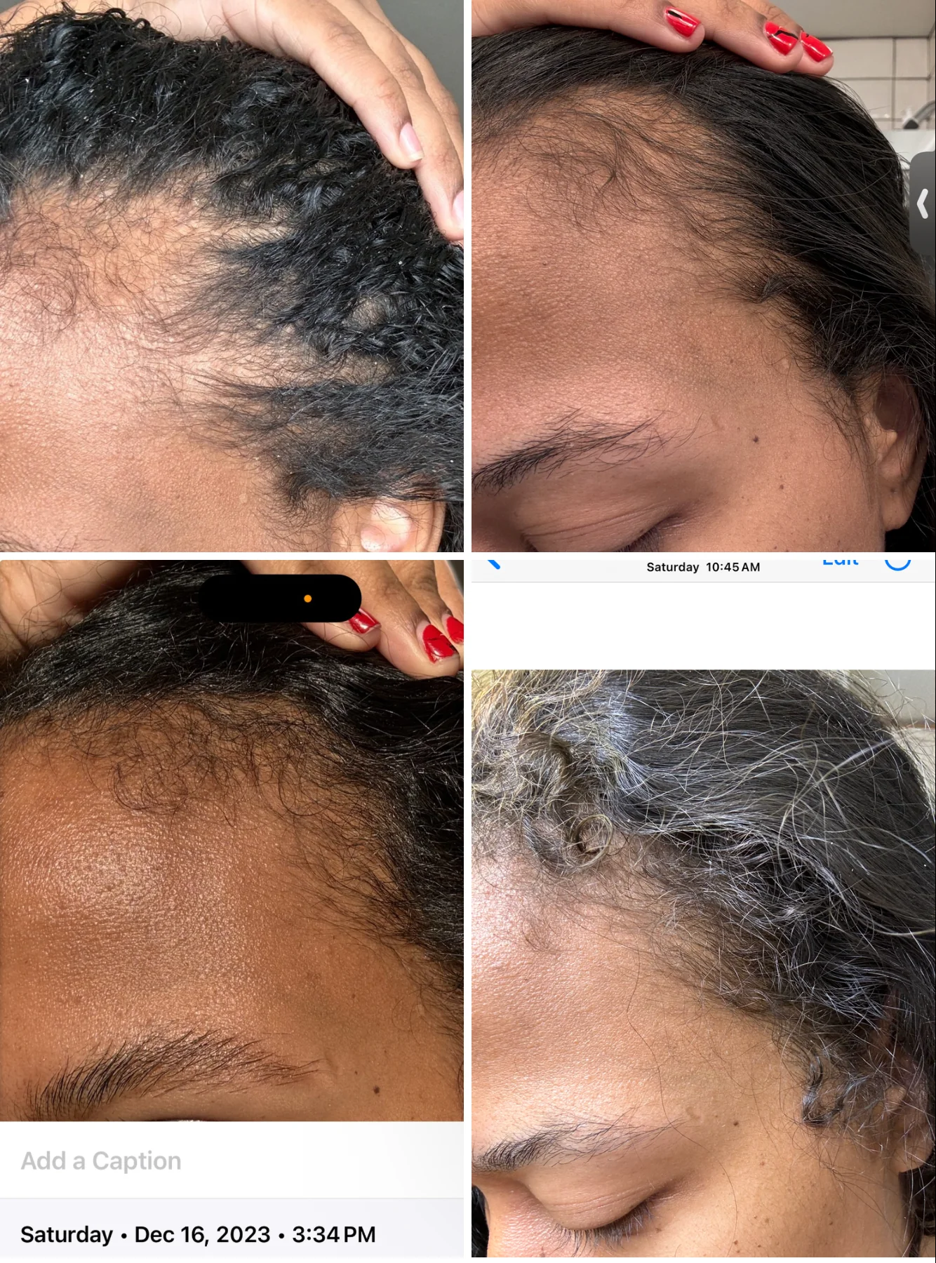 Postpartum Hair Loss
